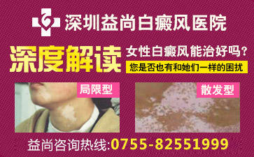 深圳宝安区白斑病医院女性患上白癜风该怎么办