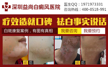 深圳白癜风注意保护皮肤